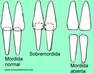 Anterior1